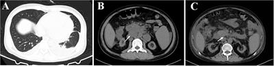 Disseminated Talaromyces marneffei infection after renal transplantation: A case report and literature review